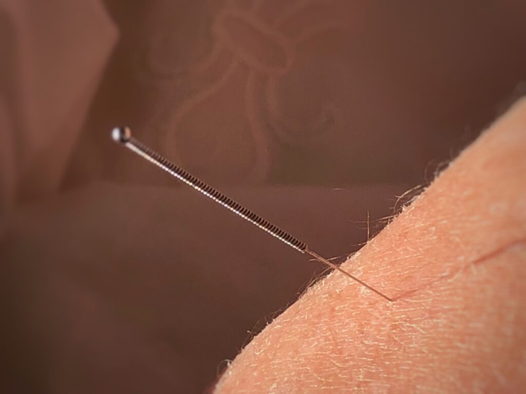 Acupuncture needle in arm
